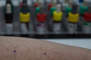 Pruebas de alergia